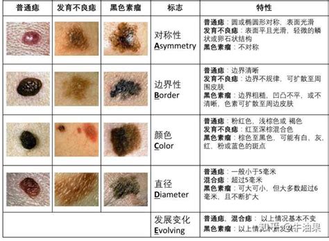 痣中痣|痣是什麼？會變成黑色素瘤？7種一定要除的痣